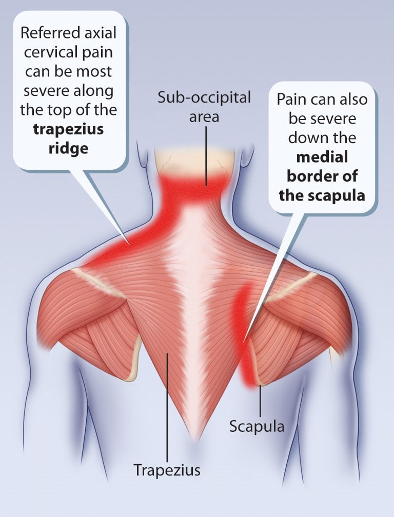 Got Shoulder Pain? Don't be surprised if your massage therapist starts  working on your neck., San Diego Massage Experts
